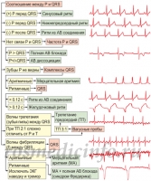 Нарушения сердечного ритма с визуальными примерами