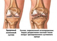 Танезумаб - лекарство против остеоартрита успешно прошло все испытания