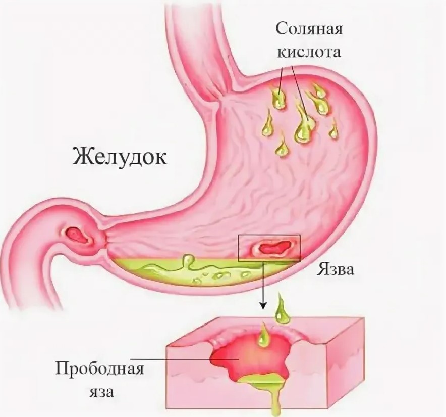 Симптомы прободной язвы желудка и двенадцатиперстной кишки