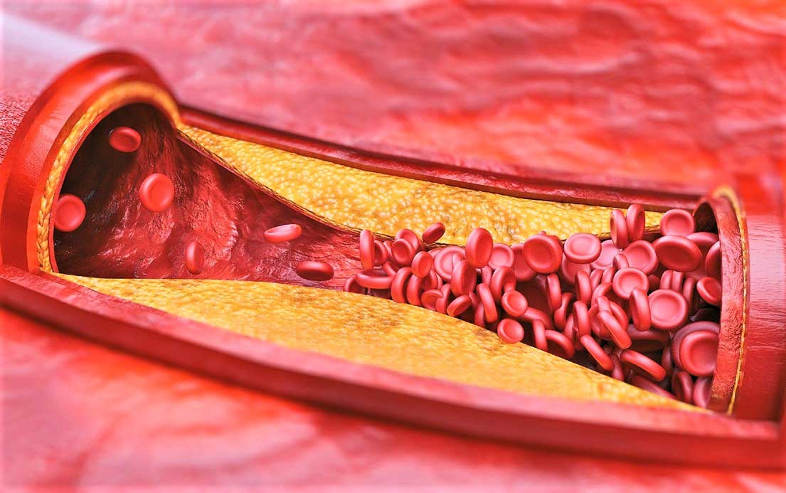 Артериосклероз: причины, последствия и лечение