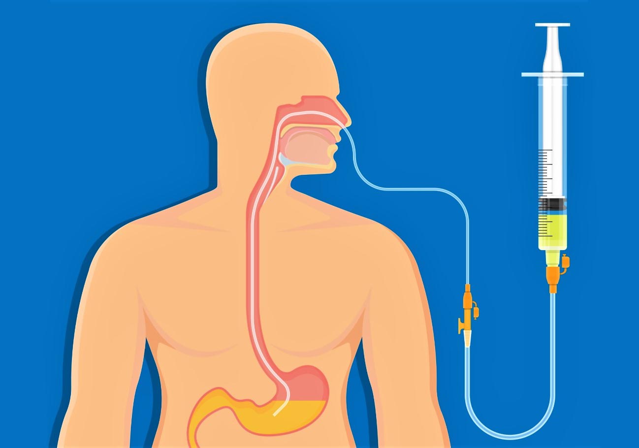 Назогастральное введения лекарственных средств