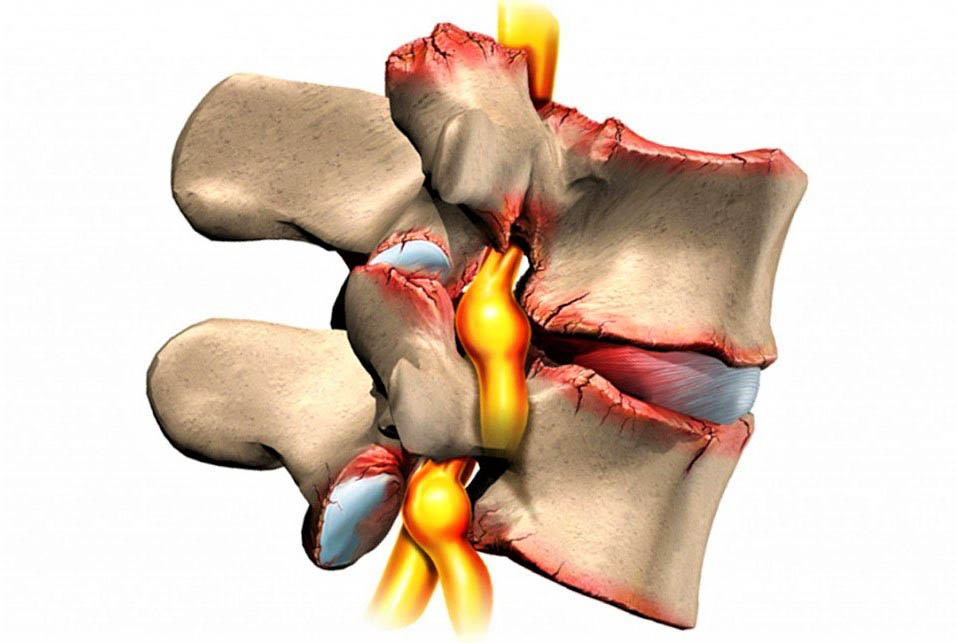 Грыжа шморля: симптомы, диагностика и лечение