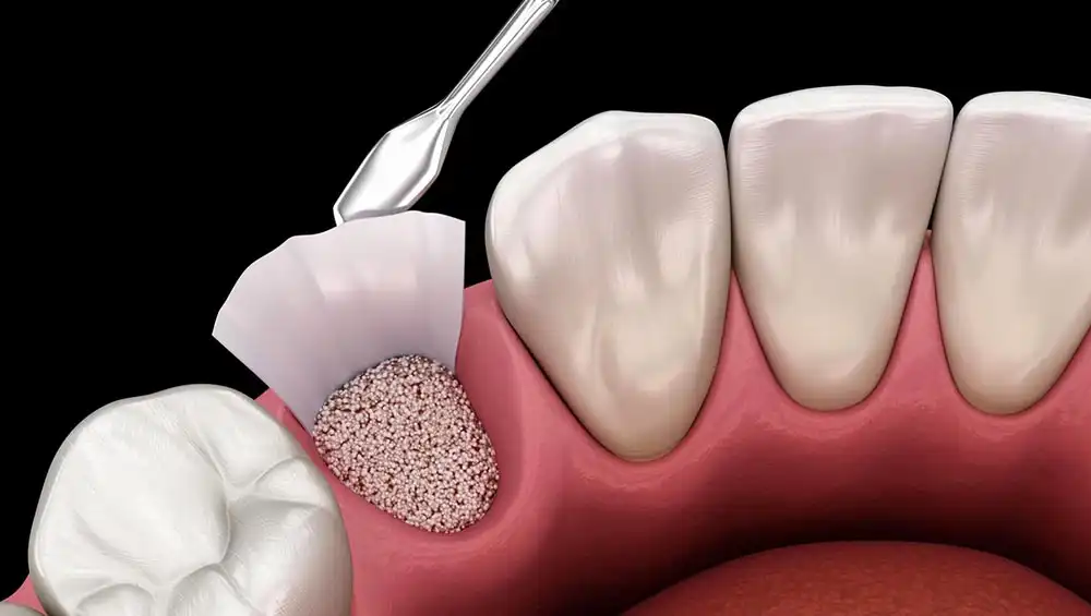Ответы к тестам НМО: "Применение остеопластических материалов в хирургической стоматологии"