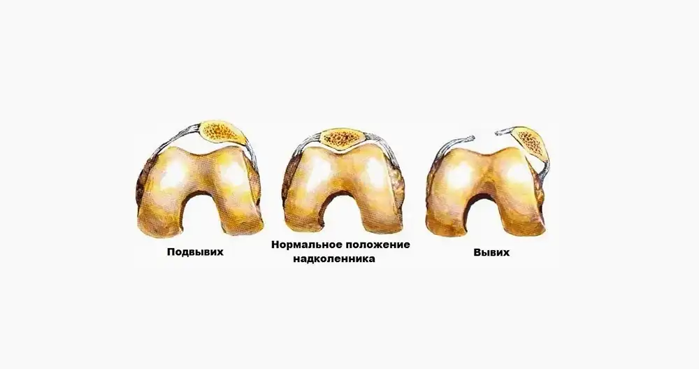 Нмо ответы ректоцеле по утвержденным клиническим рекомендациям